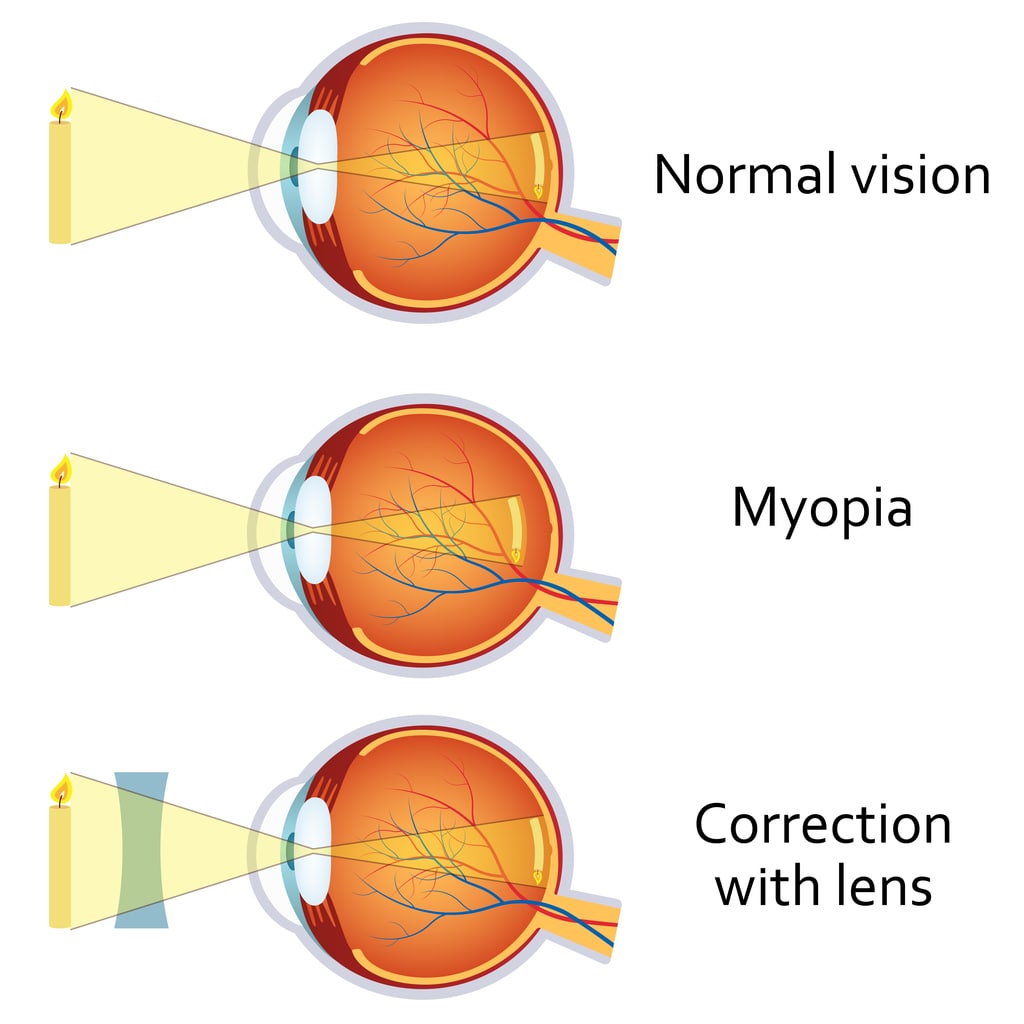 estructura de la miopía en niños