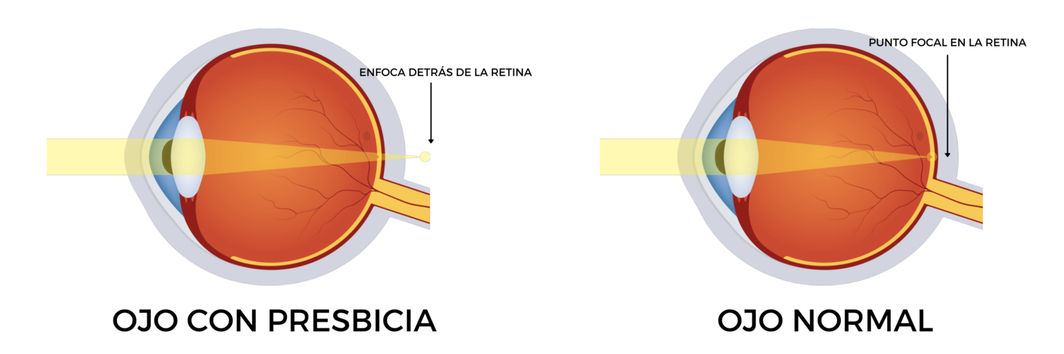 operación presbicia