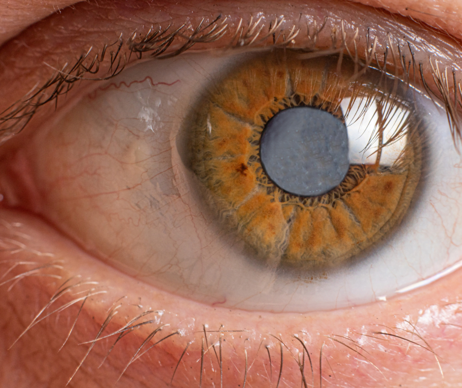 lente intraocular sucia