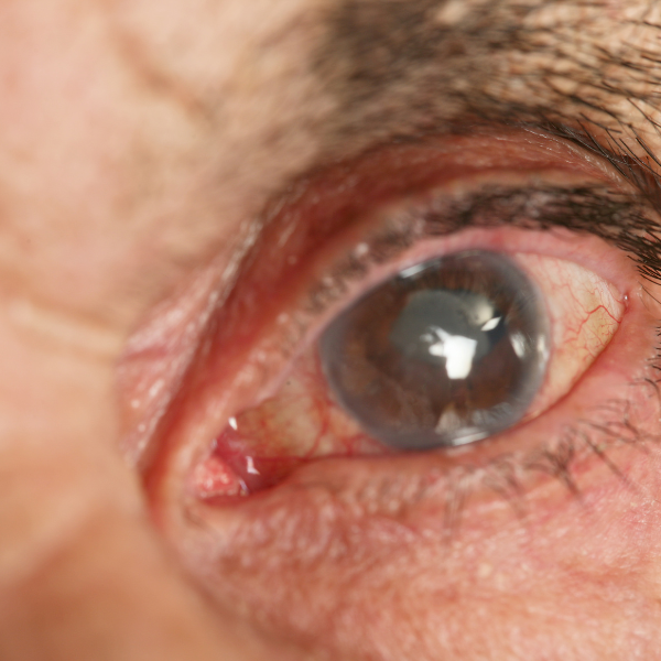 Síntomas primarios de cataratas