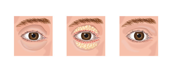 blefaroplastia superior