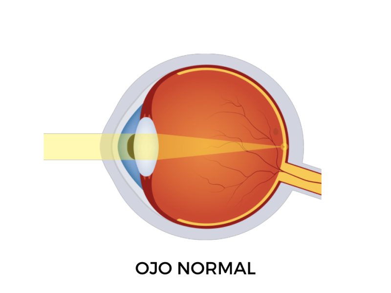 ojo sin hipermetropía infantil