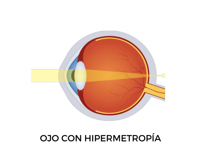 ojo con hipermetropía infantil