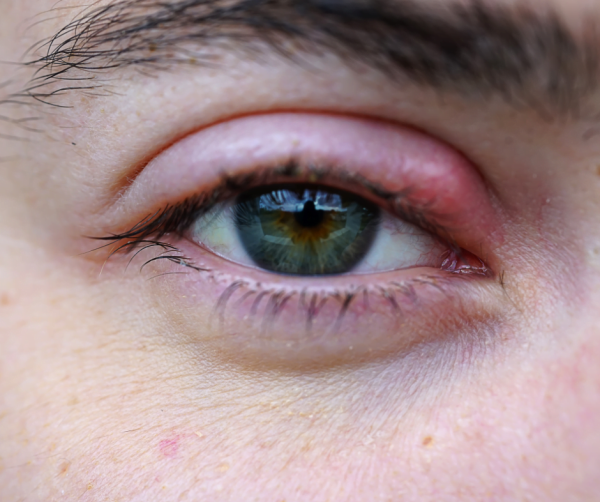 ¿Por qué aparecen los orzuelos?