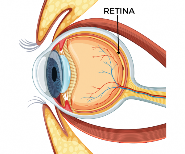desprendimiento de retina causas