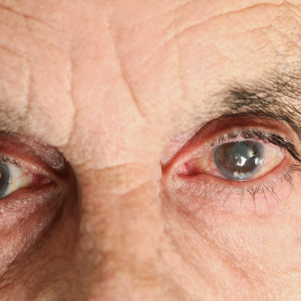 es dolorosa la operacion de cataratas